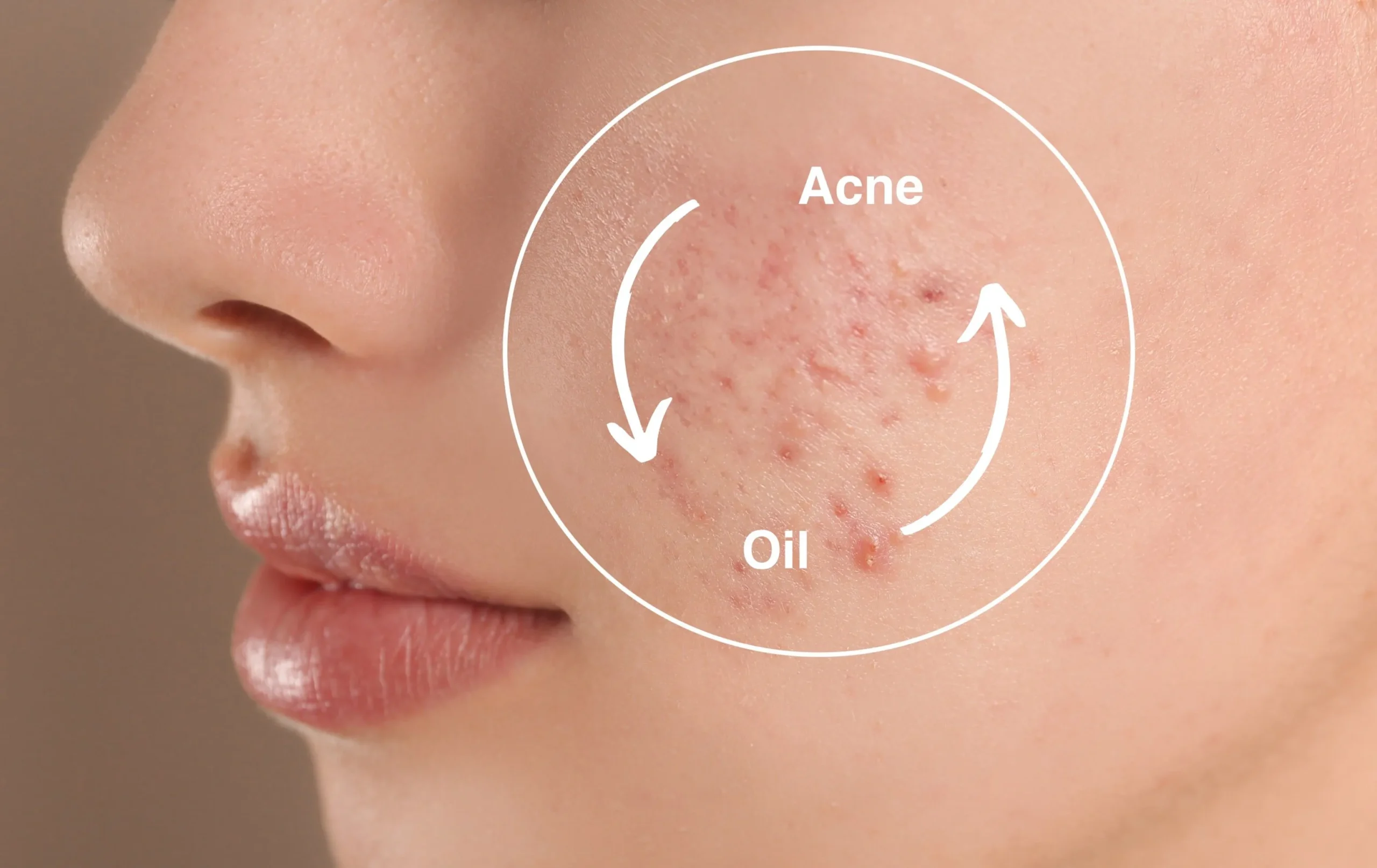 Acne-Prone Skin